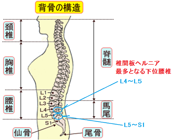椎間板ヘルニアに最も多い部位は下位腰椎のL4～L5、L5～S1.png